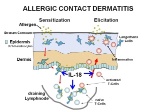 Allergcontact dermatitis